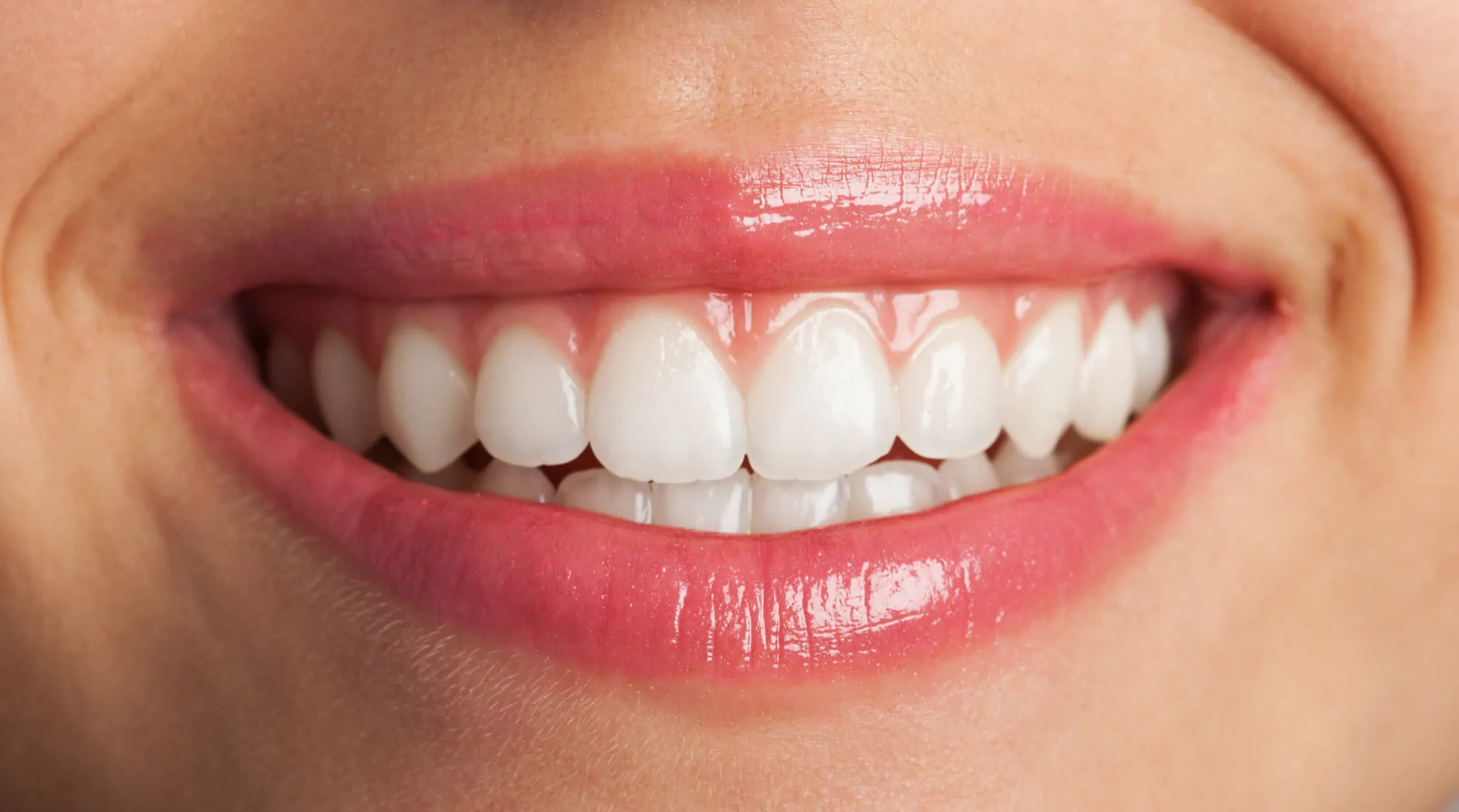 Close-up de um sorriso feminino saudável com gengiva rosa e dentes brancos, representando o tratamento de periodontia na clínica Ferdinand Odontologia, na Tijuca, RJ