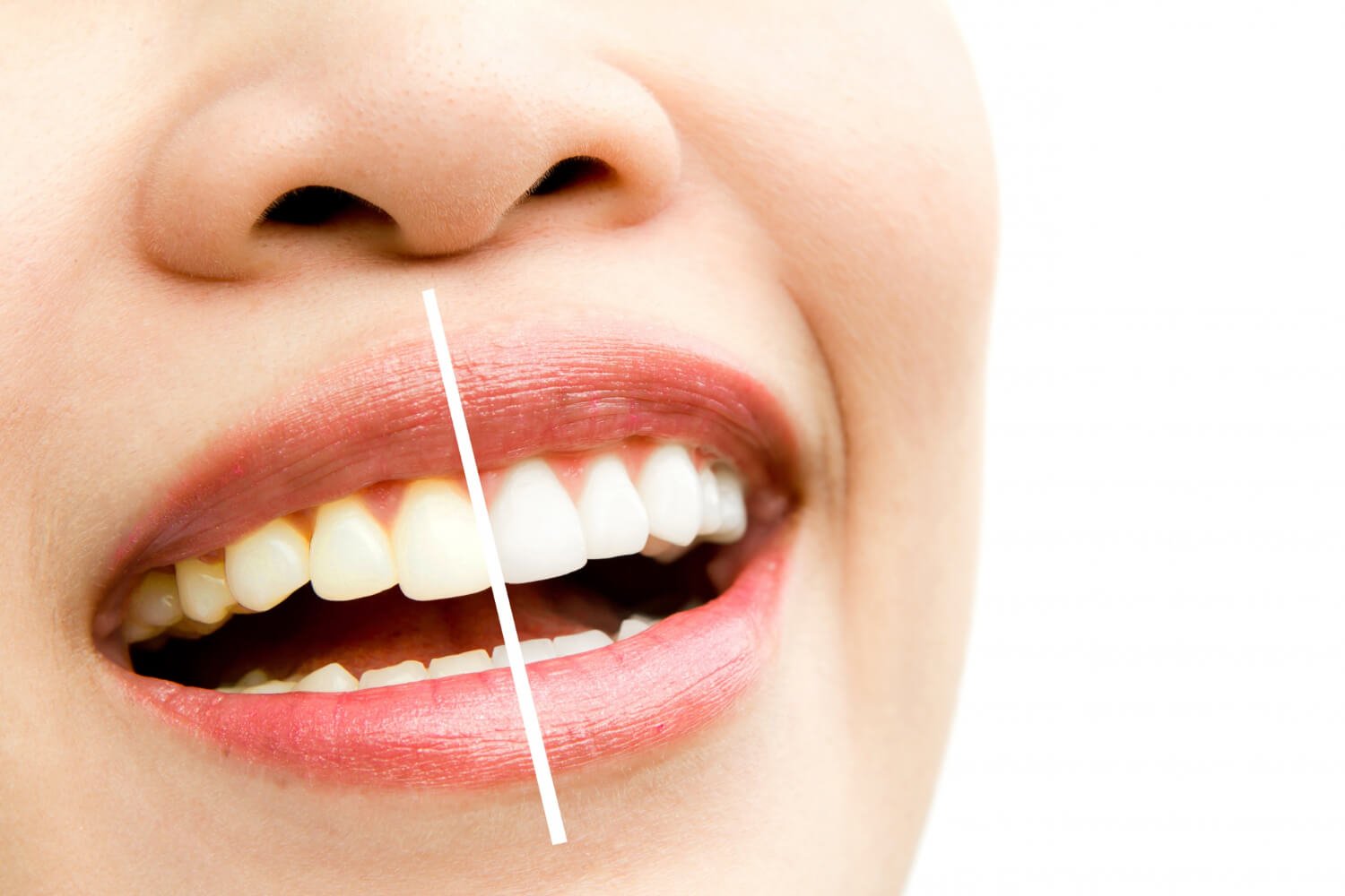 Comparação antes e depois de clareamento dental com sorriso dividido ao meio na Spazio Vita, clínica odontológica em Linhares ES.